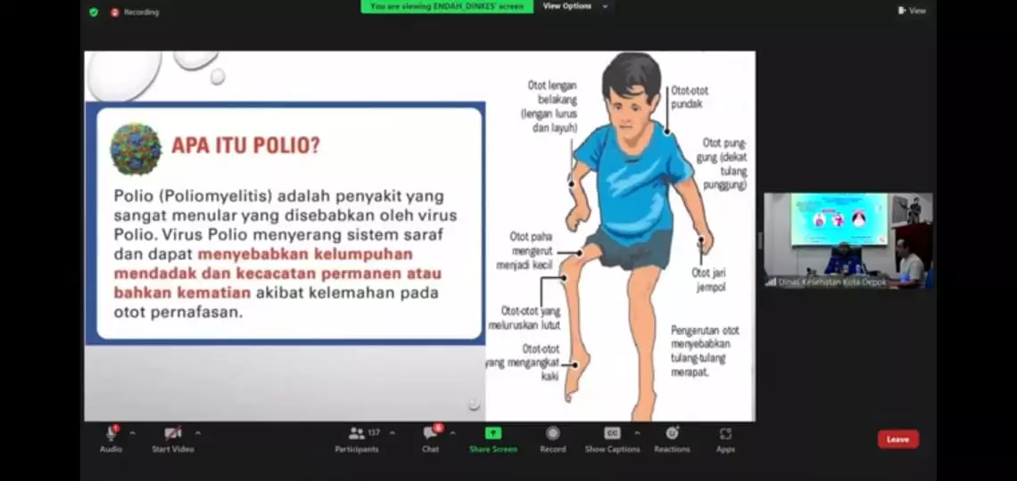 Kenali Gejala Penyakit Polio dan Penyebarannya
