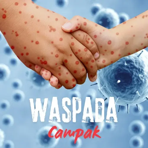 Ribuan Kasus Suspek Campak di Indonesia, Depok Catat 1.365 Kasus
